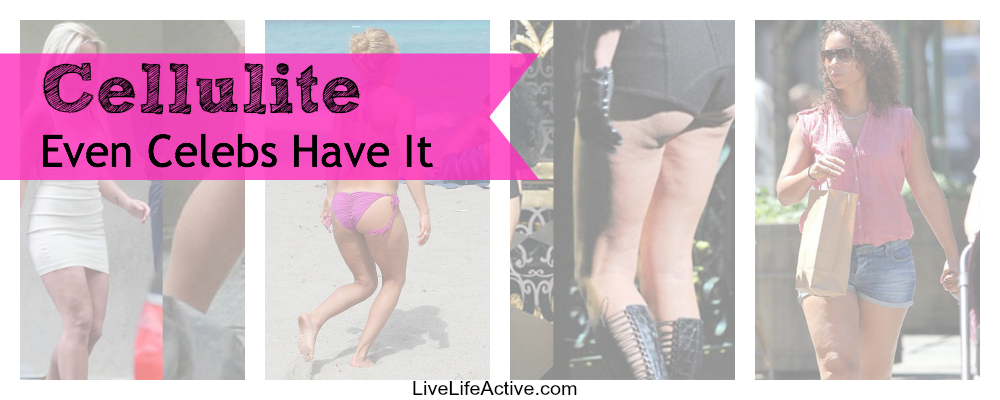 Cellulite - Even Celebrities Have it. What is cellulite and how to get rid of cellulite