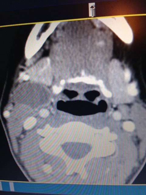 CT Scan Cervical Branchial Cleft Cyst
