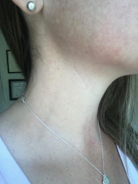 branchial cleft cyst surgery after picture of scar 5 years after - neck dissection scar