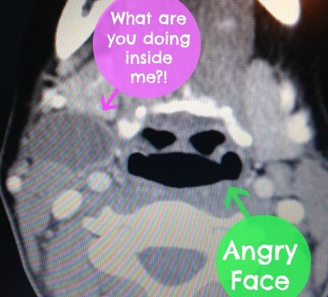 ct scan branchial cleft cyst swollen lymph node